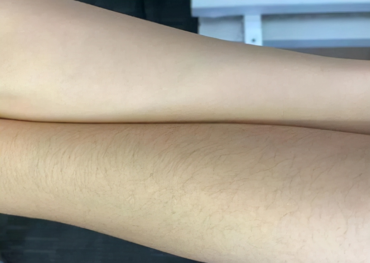 女性体毛重的症状,女性体毛多是什么原因导致的