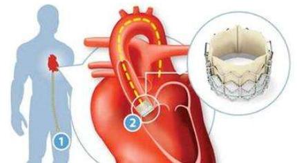 脑血管核磁共振具体检查过程,脑血管核磁共振前要注意什么
