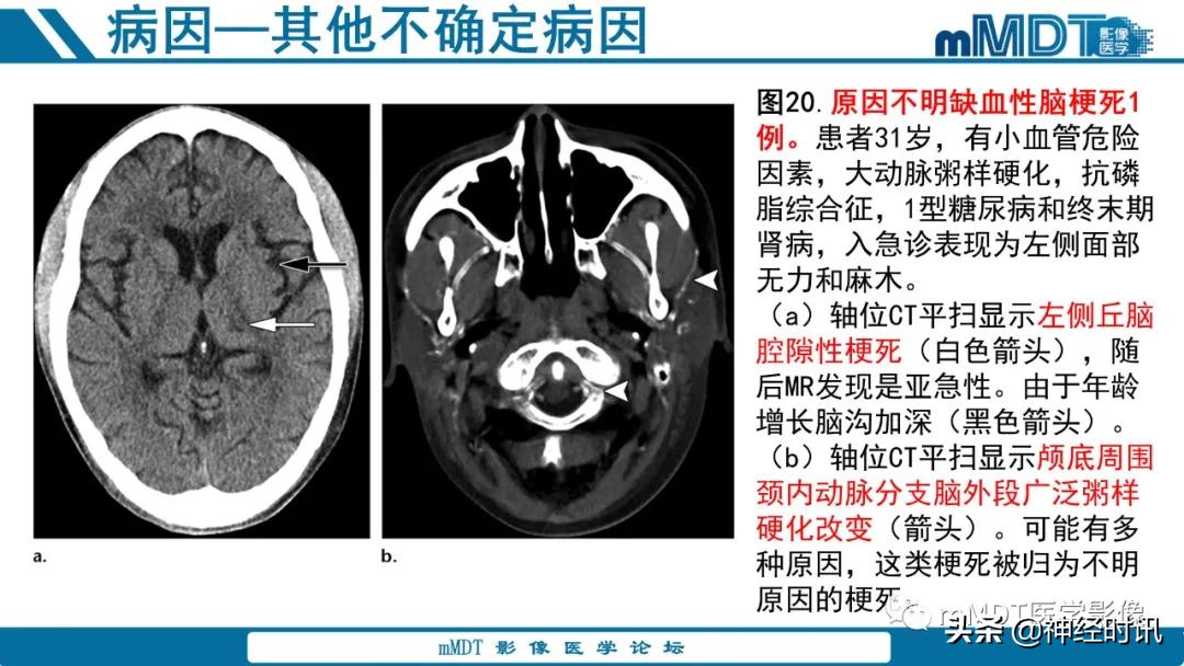 缺血性脑卒中护理课件,缺血性脑卒中讲课ppt