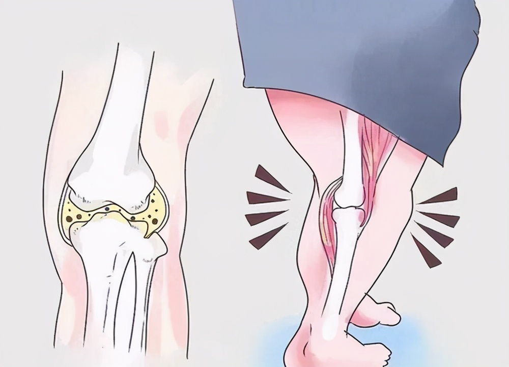 痛风怎么样才算彻底治愈,为了告别痛风要做到这四点