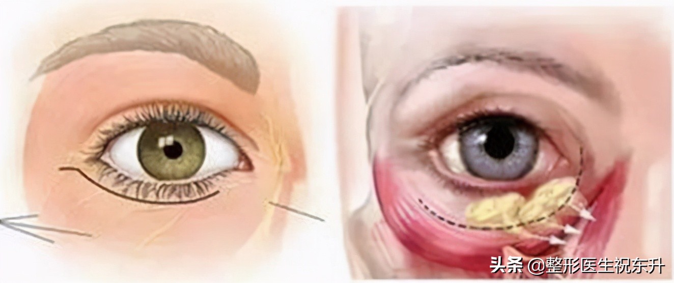 眼袋泪沟怎么解决最有效,眼袋有泪沟怎么治好得快