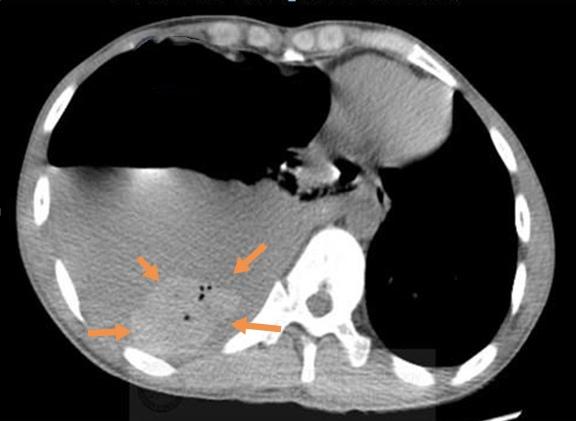打个喷嚏结果鼻血流出来,打个喷嚏吐出一口血怎么回事