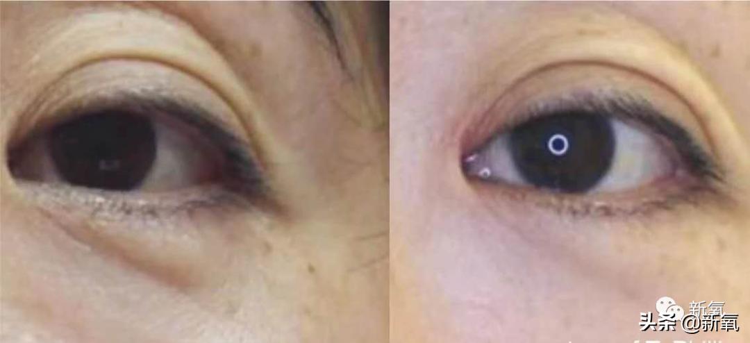 关晓彤怎样去泪沟,关晓彤眼袋去除视频