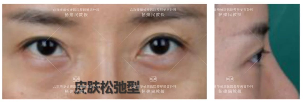 如何分清自己是哪种类型的眼袋,怎么看是哪种类型的眼袋