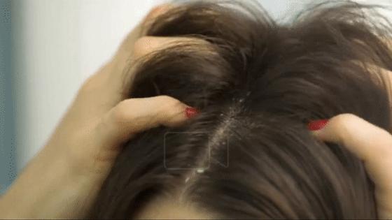 头皮痒螨虫成千上万,头皮痒是病的前兆螨虫作怪吗