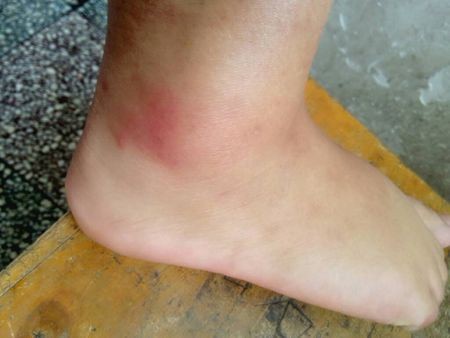 脚崴了可以用白酒擦拭吗,崴脚用白酒擦了还能冷敷吗