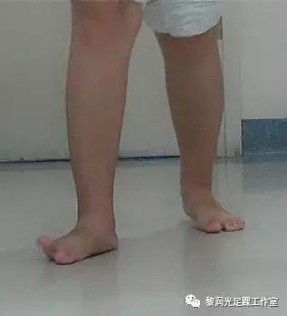 伊里扎洛夫外固定架治疗足部畸形,足部畸形矫正的技巧