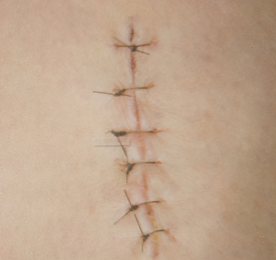 腹部切口感染正确处理方法,切口感染的原因有哪些