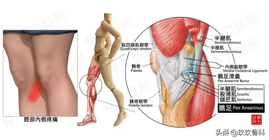 鹅足肌腱炎是不是膝关节炎,不明原因脚筋痛