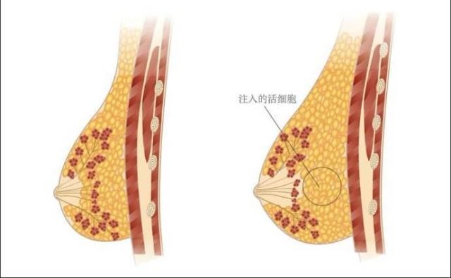 自体脂肪怎么丰胸简单,自体脂肪手术丰胸怎么消除结节