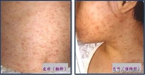 孩子发热出疹子怎么办,身上出疹子就是幼儿急疹吗