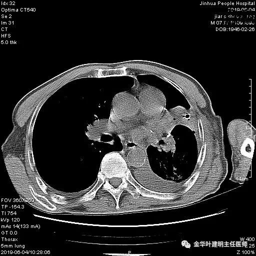 手术引起乳糜胸,有没有做了肺结节手术后是误诊的