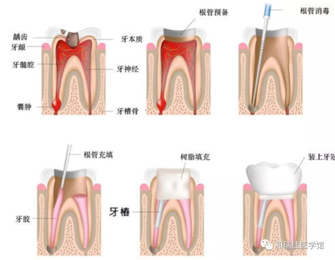 补牙与根管治疗需要多少钱,补牙与根管治疗的区别