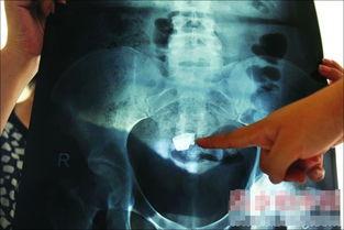 女子纱布入腹死亡，这样的悲剧完全可以避免，来看外科医生的分析