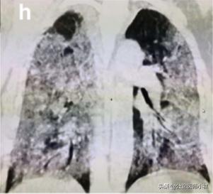 新型冠状病毒肺炎患者的肺,新型冠状病毒患者肺部体征