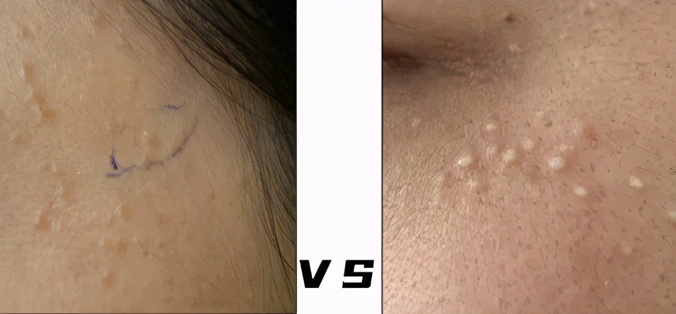 脂肪粒跟肿瘤的区别,脂肪粒也是肿瘤吗