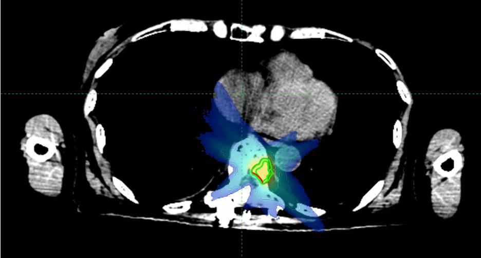 华东首秀！M6型射波刀落户国科大肿瘤医院
