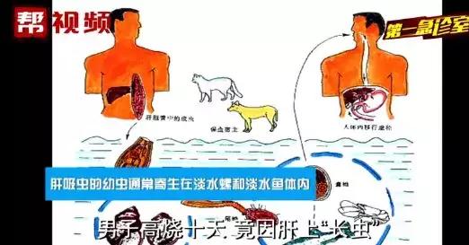 可怕男子高烧10天肝脏惊现寄生虫,男子高烧10天肝脏发现寄生虫
