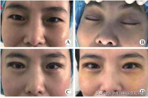 尚雯婕单眼皮吗,尚雯婕参加王牌视频