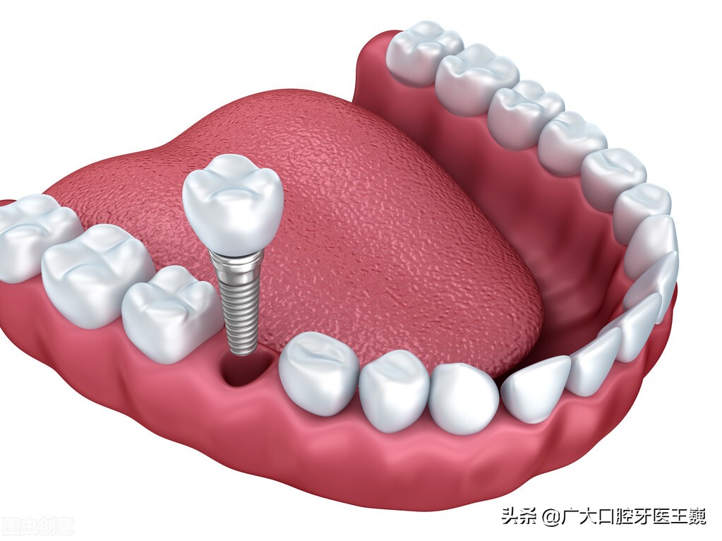 医生建议不拔牙而补牙的好处,牙齿坏得严重建议拔牙还是补牙