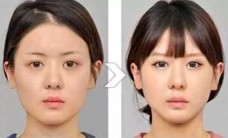 揭秘瘦脸针受欢迎的五大原因,瘦脸针人人都可以打吗科普篇