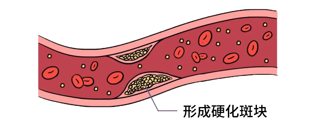 血脂多少需要吃药降血脂,血脂多少必须吃降血脂的药