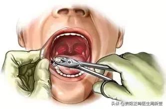 拔牙有什么好方法吗,拔牙有什么好办法不痛