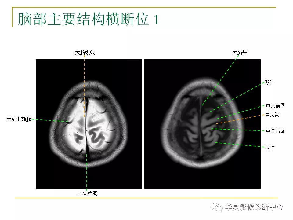 中国人脑立体定向mri应用解剖图谱,脑mri示意图