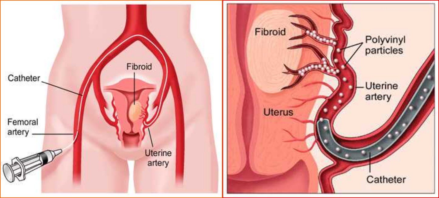 子宫腺肌症「不死的癌症」——介入栓塞来帮忙