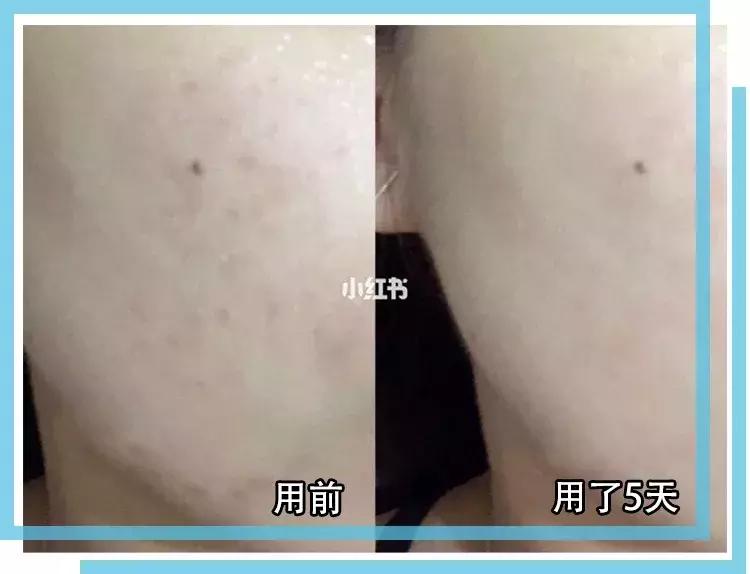 如何有效的祛痘印医美面膜,消炎祛痘的医美面膜