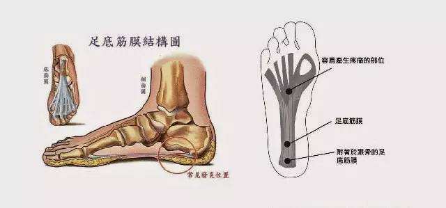治好足底筋膜炎的一个意外方法,足底筋膜炎严重到无法行走