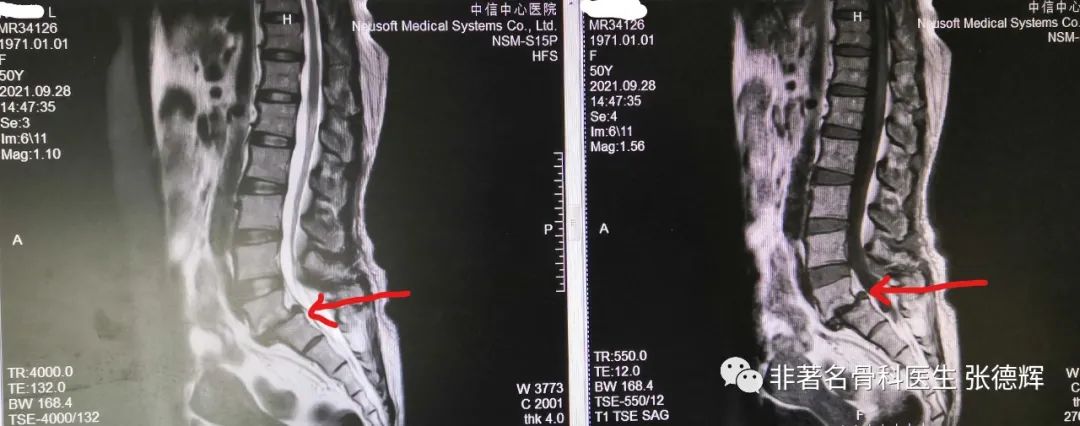 腰椎真性滑脱，手术复位融合固定