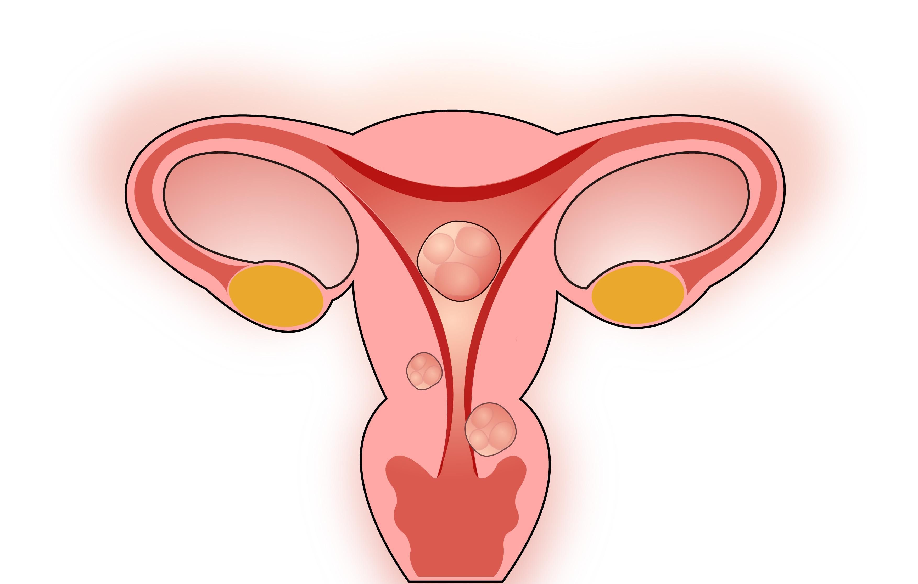 妇科恶性肿瘤严重威胁女性的健康，其发病与生殖道菌群的关系密切