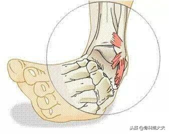 脚扭伤如何冰敷,脚扭伤了怎么冰敷效果最好