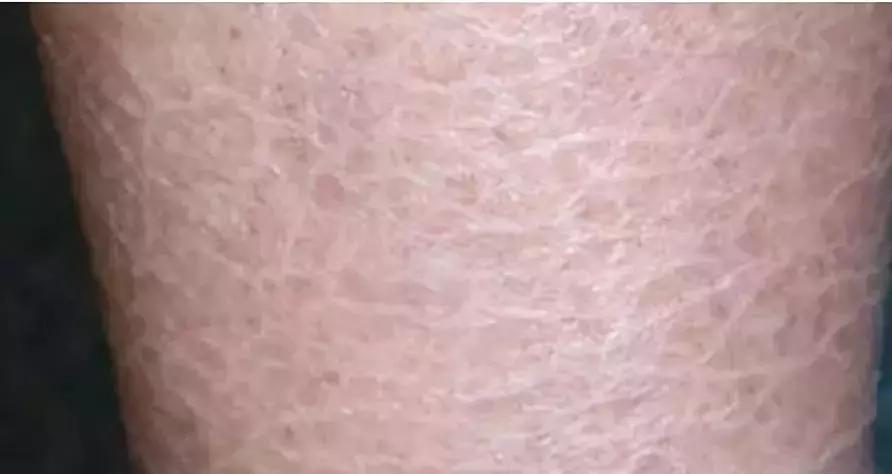 脚后跟像鱼鳞一样一层层干裂中医,脚后跟干裂腿部出现鱼鳞纹