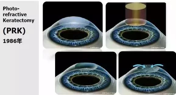 目前矫正近视手术全飞秒和半飞秒,近视眼手术全飞秒半飞秒怎么选择