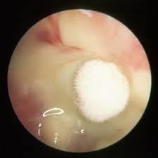 耳朵流脓要用滴耳液吗,耳朵流脓可以滴耳液么