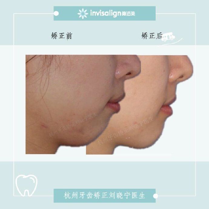 杭州牙齿矫正丨露龈笑怎么办？全面告别露龈笑的4大方法