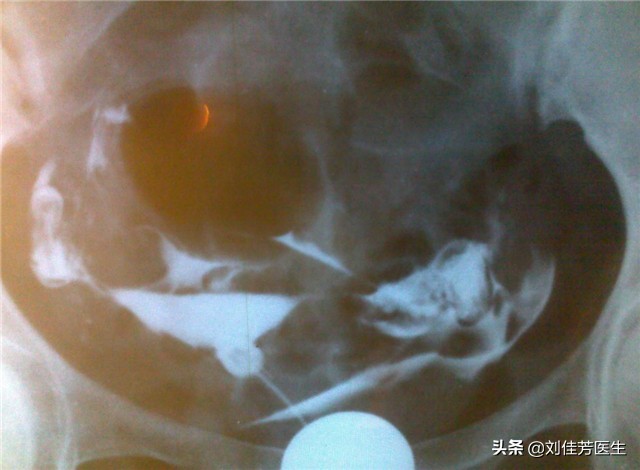 疏通输卵管堵塞的最佳时间和方法,出现输卵管堵塞怎么疏通最快