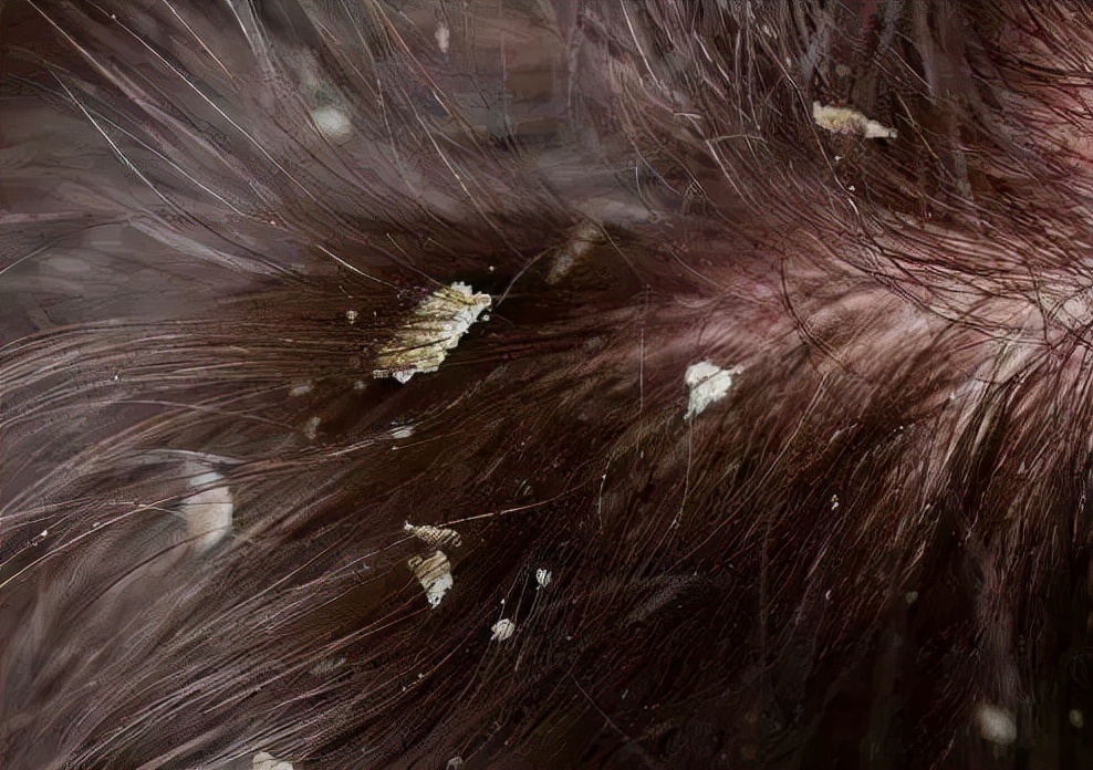 头皮屑严重如何处理好得快,头皮屑是怎么导致的如何治好