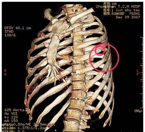 肺部ct检查一般都能发现什么问题,肺部检查应该拍片还是应该做肺ct