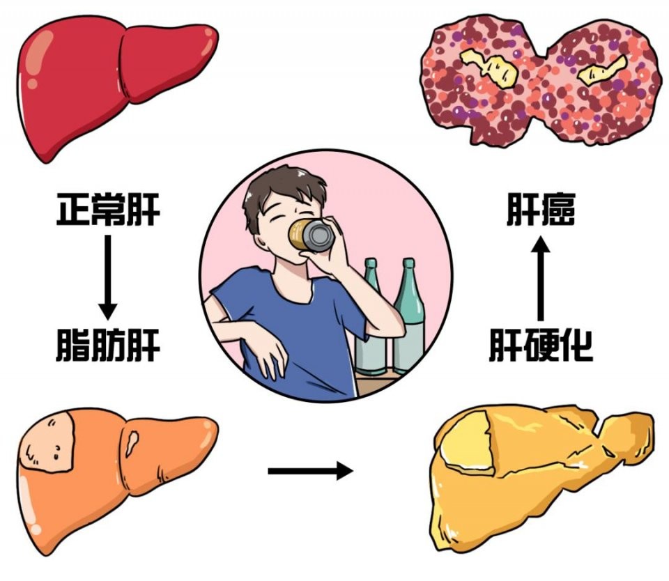 肝癌科普文章,肝癌方面的文章