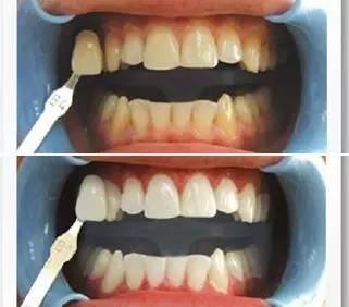 满口全瓷牙的明星李沁,李沁矫正牙齿前的照片