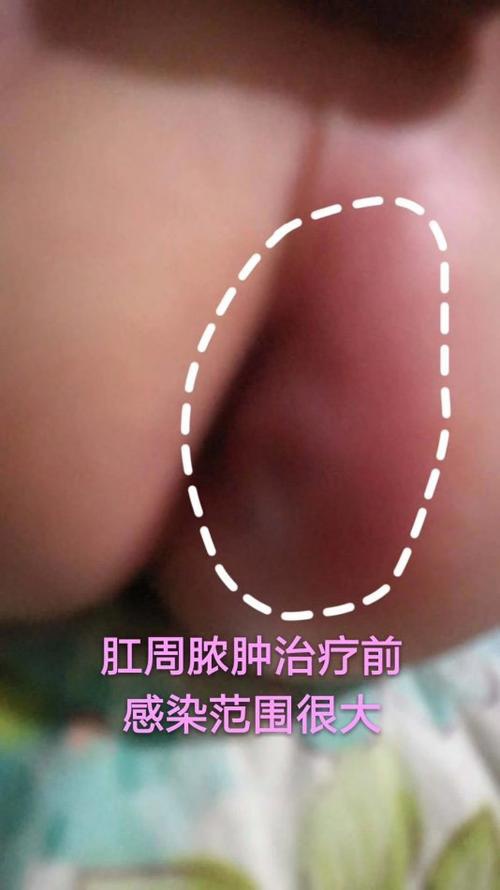 预防肛周脓肿打什么疫苗,孩子得了肛周脓肿还能接种疫苗吗