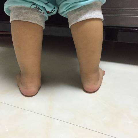 足外翻最佳治疗时间几岁,足外翻最佳治疗时间