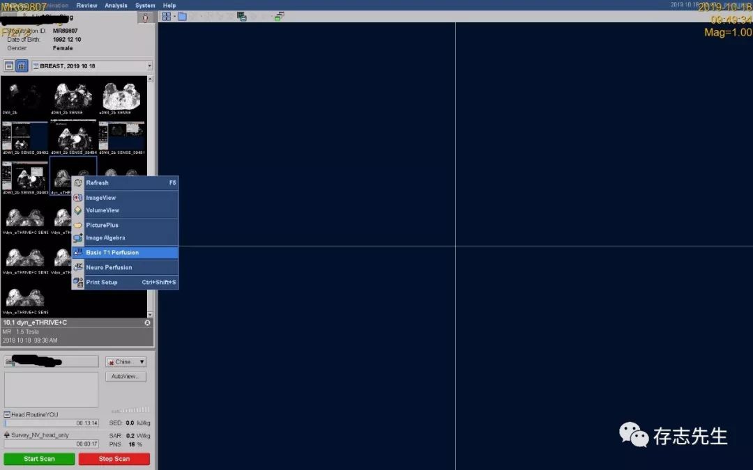 乳腺磁共振亲身经历,磁共振乳腺动态增强扫描全过程