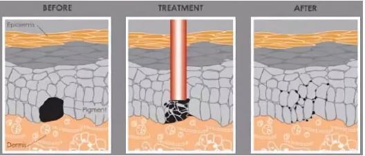 西安激光皮肤美白祛斑,激光皮秒祛斑真的有用吗
