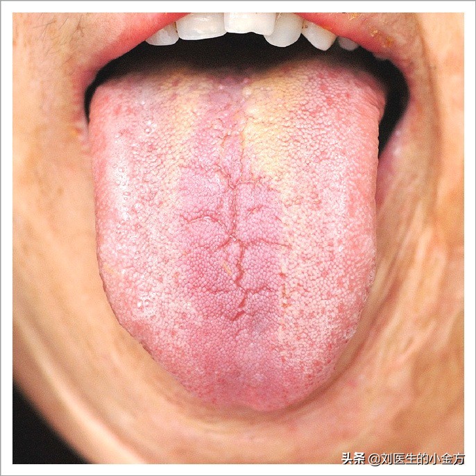 中医舌诊图解100例,中医舌诊图与舌诊口诀