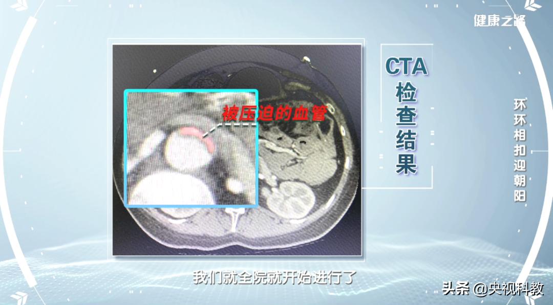 血管主动脉夹层能活多久,警惕凶险的主动脉夹层你了解多少