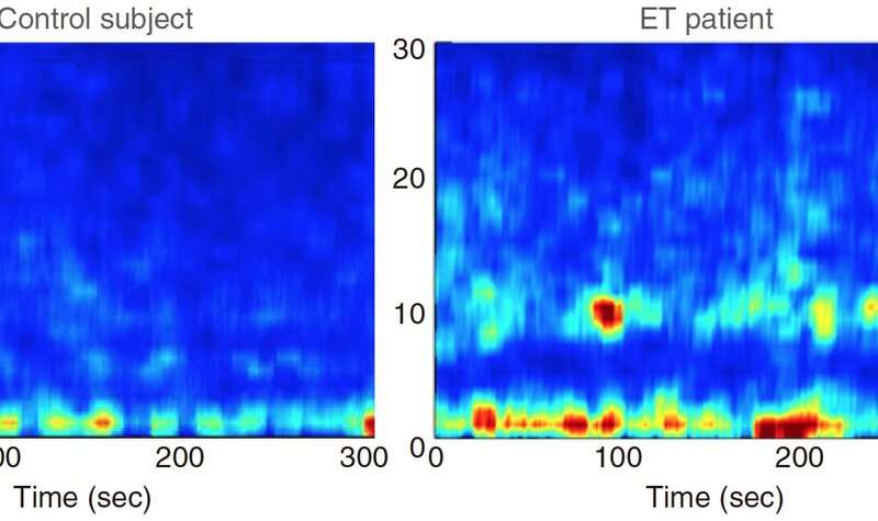 过度活跃的脑电波引起的震颤,脑电波突然上下波动正常吗